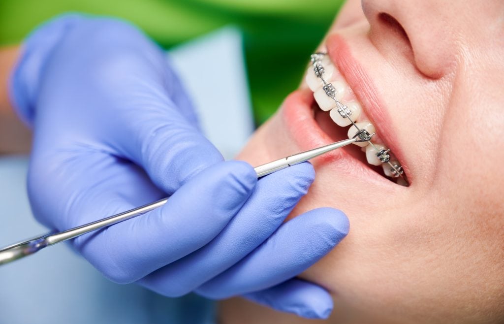 Orthodontic Extractions