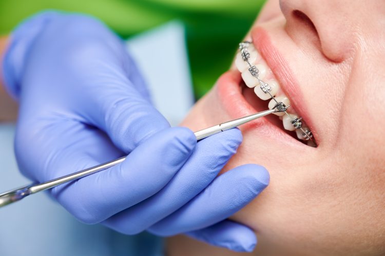 Orthodontic Extractions