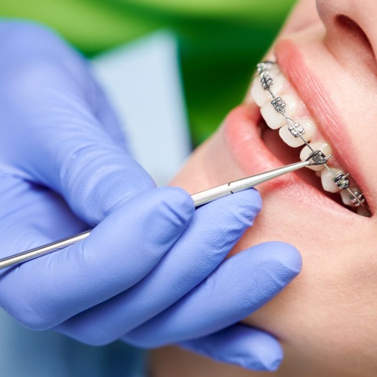 Orthodontic Extractions