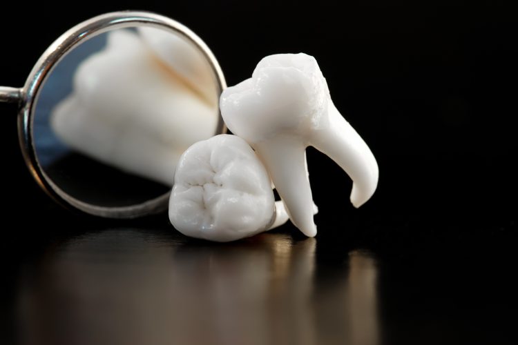 Wisdom Tooth Perth