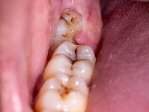 decay in a partially impacted wisdom tooth